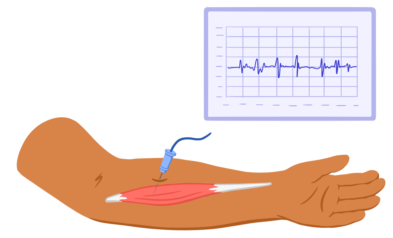 A needle electrode is inserted into the muscle of an arm. Electrical signals from the muscle can be seen on the graph nearby.